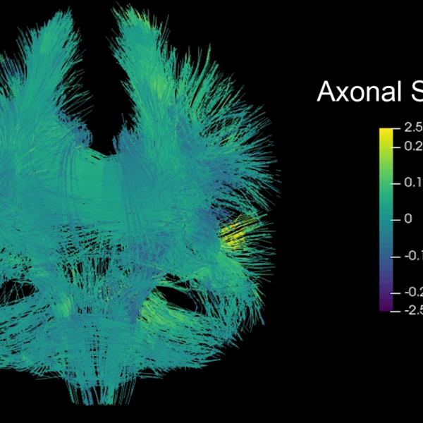 Reuben Kraft, professor of mechanical engineering in the Penn State College of Engineering, is using computational tools — such as mouthguard sensors — to model and predict injury in the human brain. Here, a 3D visualization shows deformation in the brain caused by physical impact during a game of football.  Credit: Kraft Lab. All Rights Reserved.