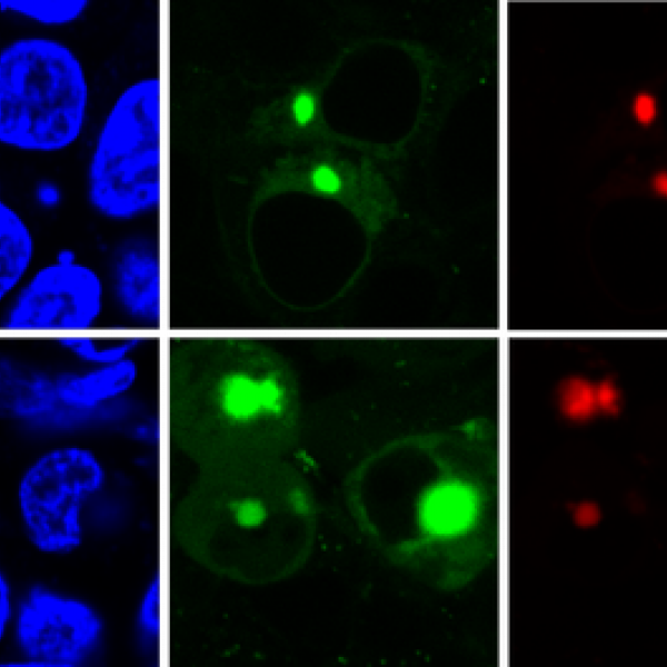 The new AggTag method allows researchers to see the previously undetectable but potentially disease-causing intermediate forms of proteins as they misfold. The method uses fluorescence to simultaneously detect two different proteins (red, green) within the cell (blue). Credit: Zhang lab, Penn State